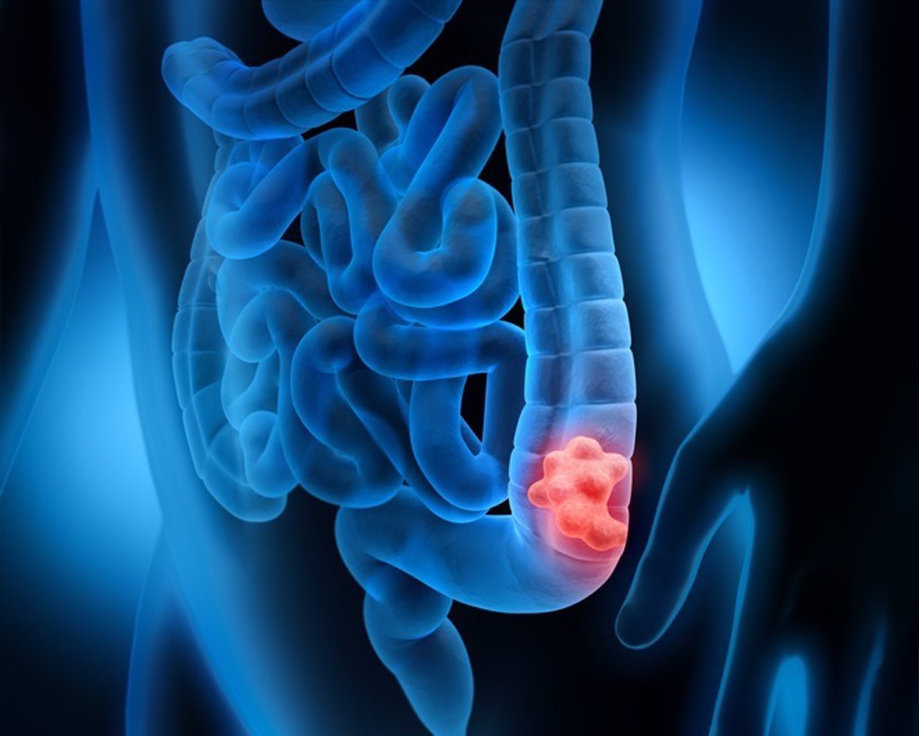Experta asegura que el dolor es el síntoma de mayor impacto del cáncer colorrectal