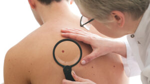 Dermatologist examines a mole